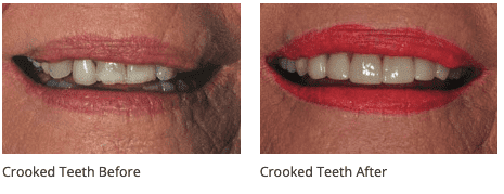 Crooked Teeth Treatment